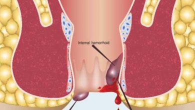 How to get rid of hemorrhoids without surgery