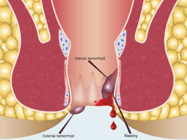 How to get rid of hemorrhoids without surgery